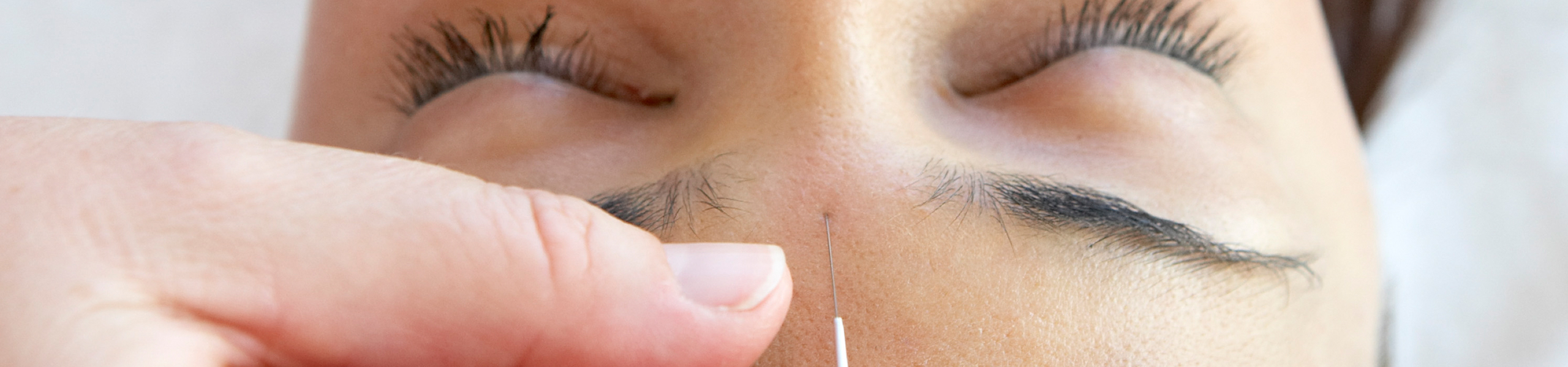 A hand gently sticks a needle into person’s forehead for acupuncture treatment