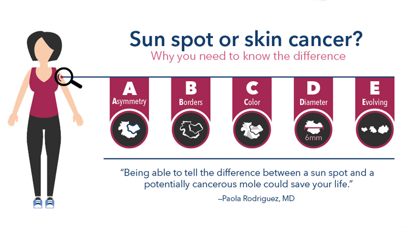 Sun Spot Or Skin Cancer Know The Difference Thrive